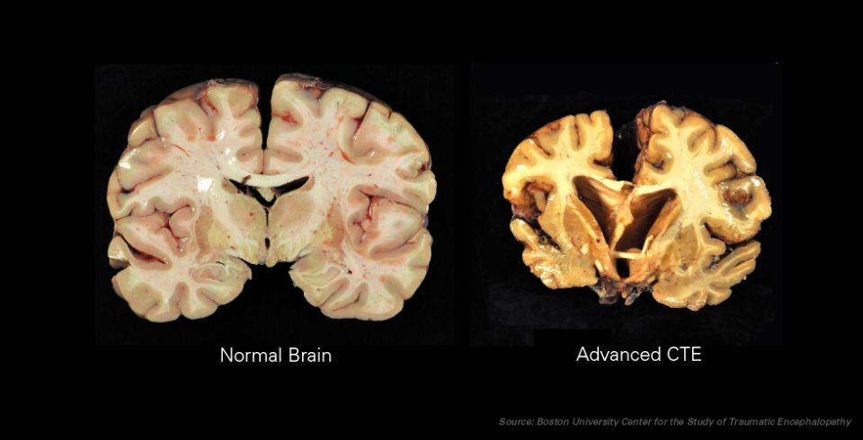 how-the-sports-world-learned-to-ignore-cte-global-sport-matters